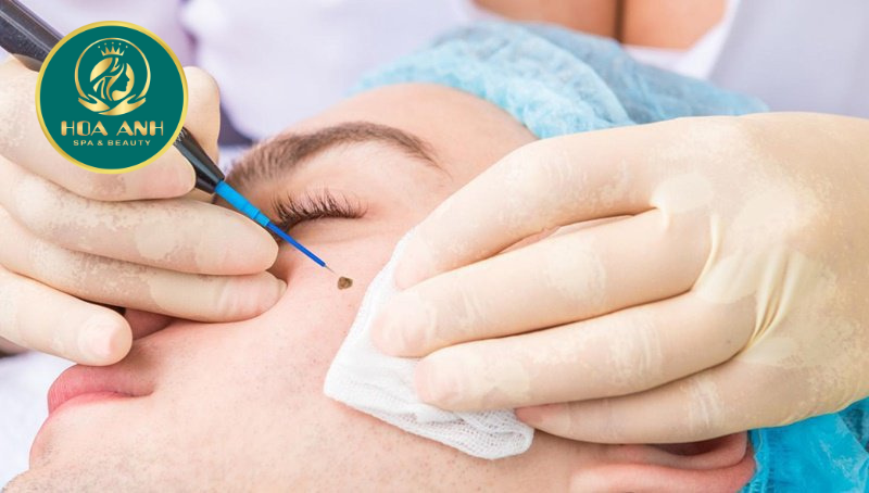 Điều trị sẹo do mụn bằng laser lợi hay hại ?